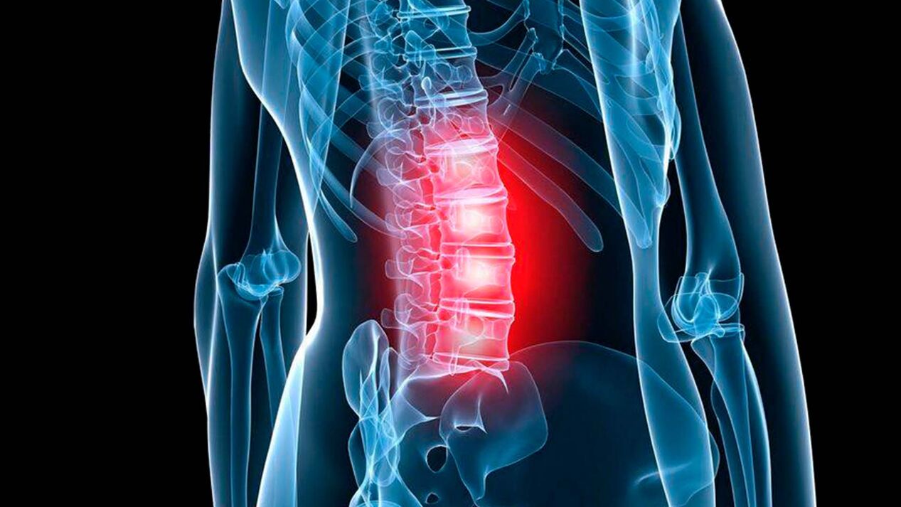 příznaky bederní osteochondrózy