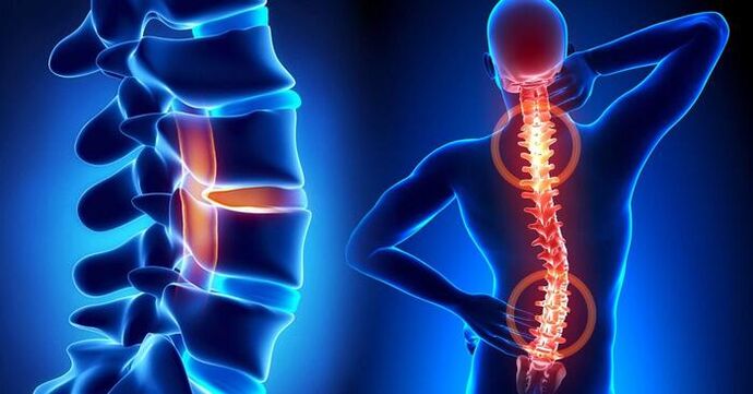 lokalizace bolesti při osteochondróze